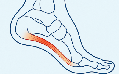 Plantar Fasciitis